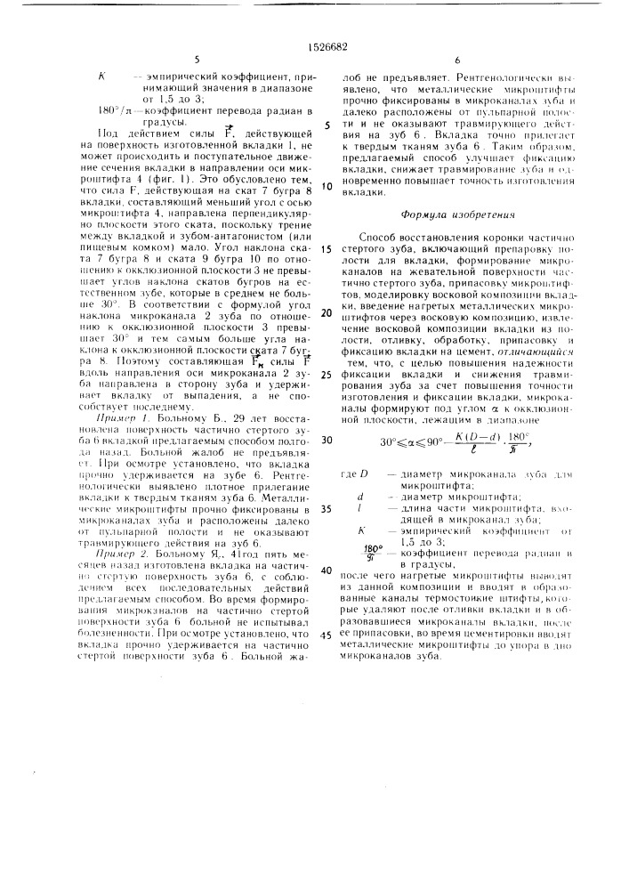 Способ восстановления коронки частичного стертого зуба (патент 1526682)