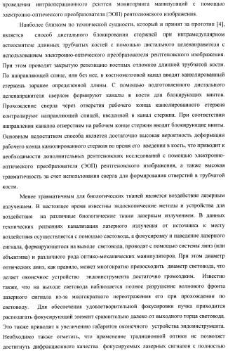 Способ дистального блокирования интрамедуллярных стержней при остеосинтезе длинных трубчатых костей и устройство для его осуществления (патент 2387401)