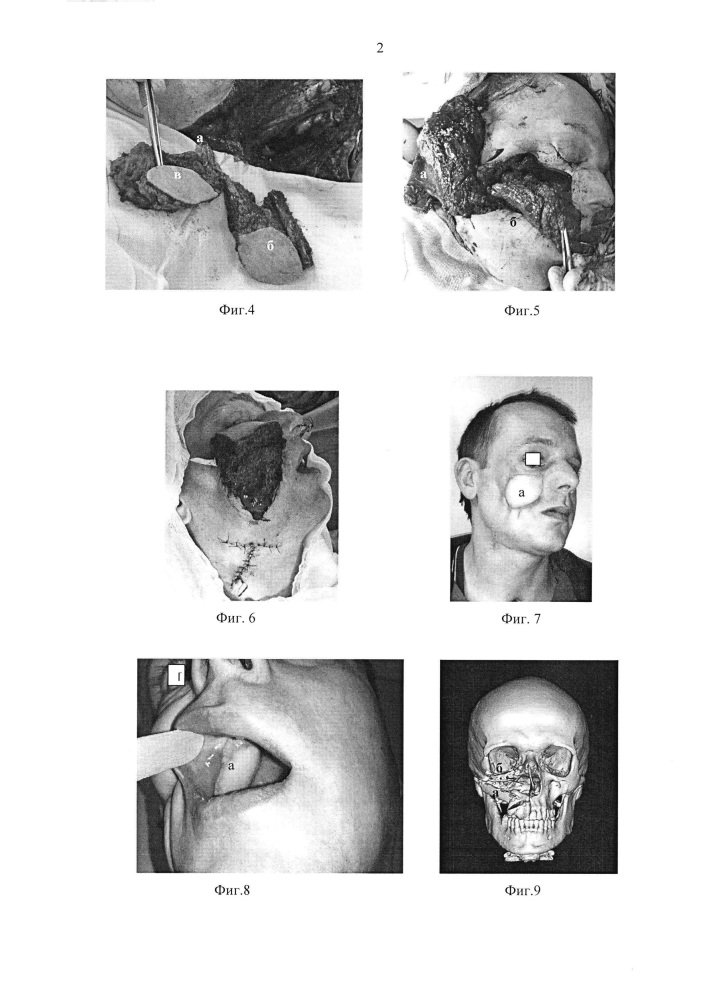Способ замещения орбито-оро-фациальных дефектов сложнокомпонентным лоскутом с одномоментной реконструкцией нижней стенки орбиты (патент 2617886)