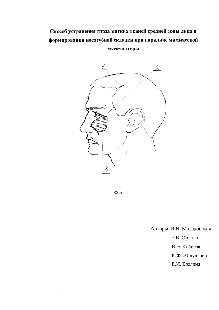 Способ устранения птоза мягких тканей средней зоны лица и формирования носогубной складки при параличе мимической мускулатуры (патент 2639811)