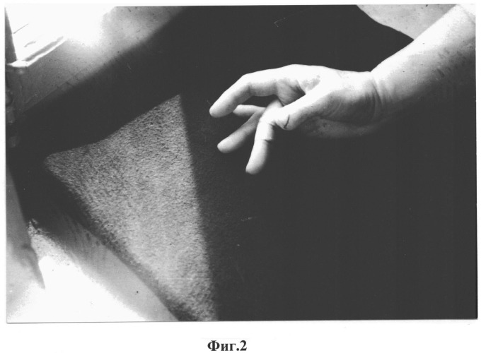 Способ формирования ногтевой фаланги i пальца кисти (патент 2548517)
