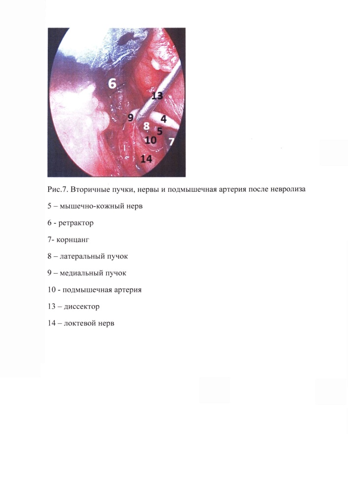 Способ эндоскопической ревизии, невролиза и декомпрессии плечевого сплетения (патент 2637616)