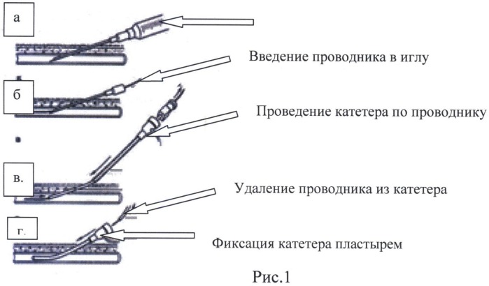 Способ катетеризации центральных вен у детей (патент 2527163)