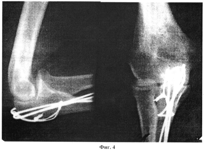 Способ остеосинтеза переломов локтевого отростка (патент 2409327)