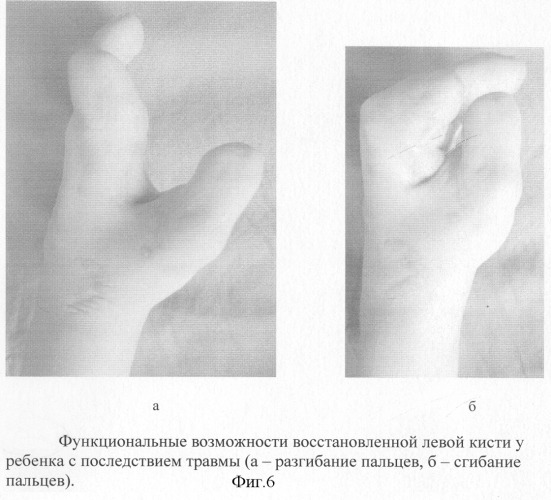 Способ реконструкции пальцев кисти у детей с последствиями травмы (патент 2278630)