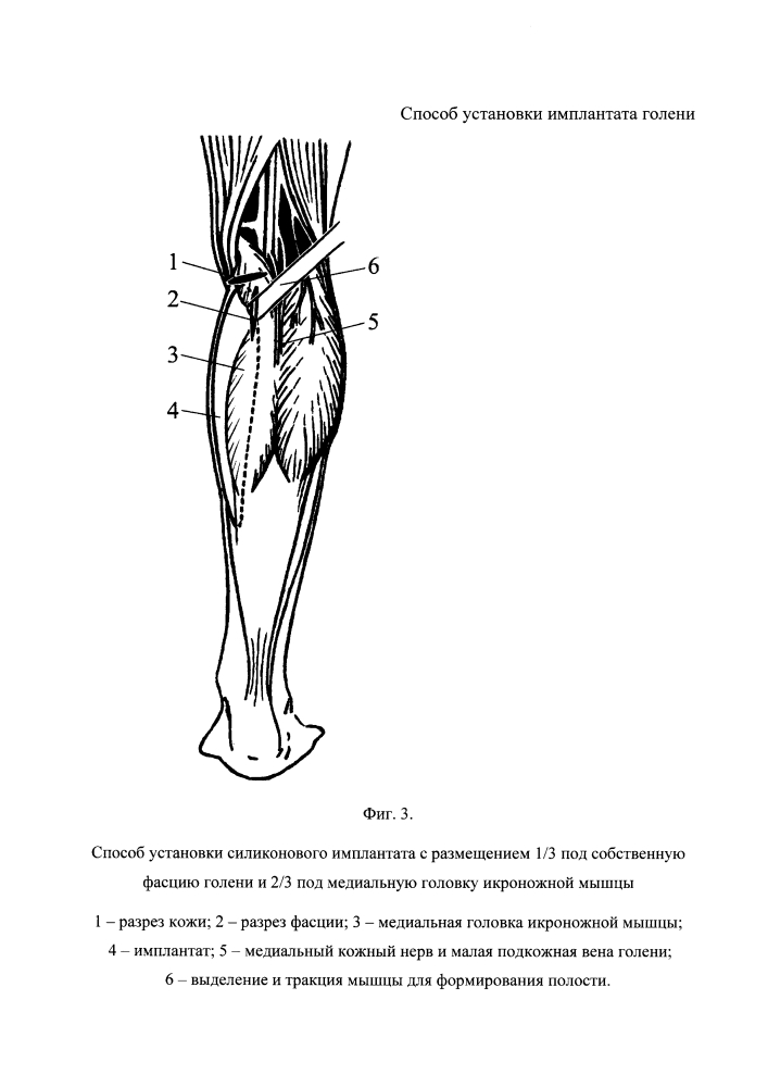Способ установки имплантата голени (патент 2626267)