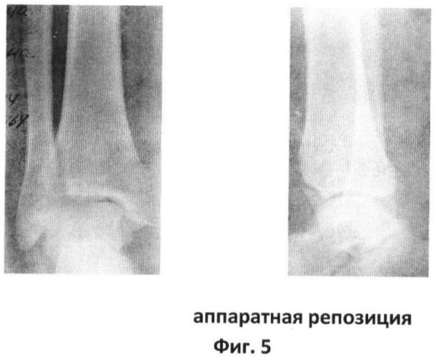 Способ закрытой управляемой динамической аппаратной репозиции переломовывихов в голеностопном суставе при их внутрисуставной костной интерпозиции (патент 2415656)