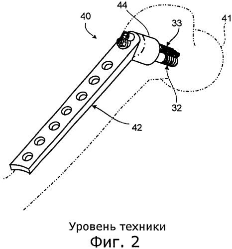 Регулирование компрессии кости (патент 2557692)