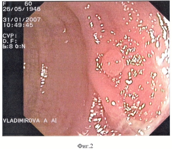 Способ определения морфологической структуры полипов толстой кишки (патент 2354280)