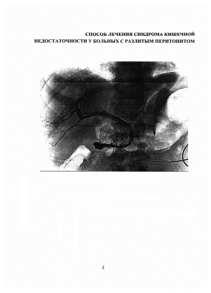 Способ лечения синдрома кишечной недостаточности у больных с разлитым перитонитом (патент 2648346)