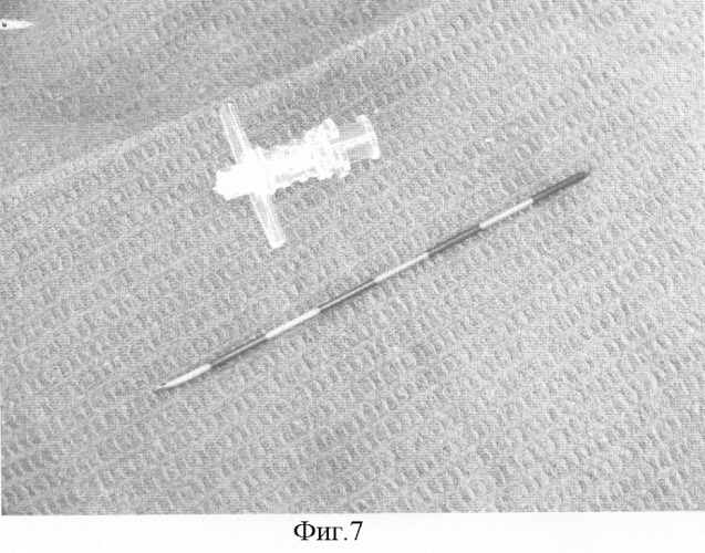 Безопасный способ постановки эпидурального катетера в &quot;туннеле&quot; для продленной аналгезии (патент 2301083)