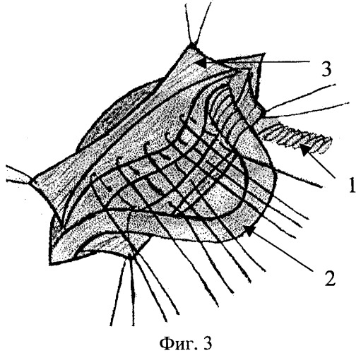 Способ герниопластики в лечении паховых грыж (патент 2277383)