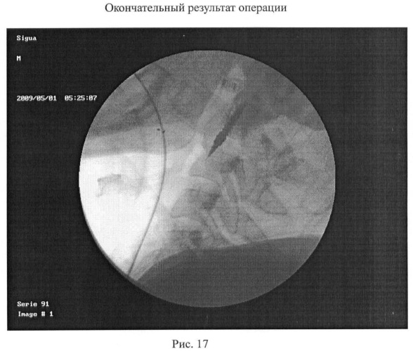 Способ анкерной коррекции и фиксации травматических дислокаций тела позвонка с2 при переломах палача (патент 2463978)