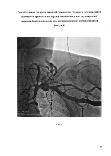 Способ лечения синдрома венозной гипертензии головного мозга и верхней конечности при окклюзии верхней полой вены и/или двусторонней окклюзии брахиоцефальных вен, ассоциированной с артериовенозной фистулой (патент 2573802)