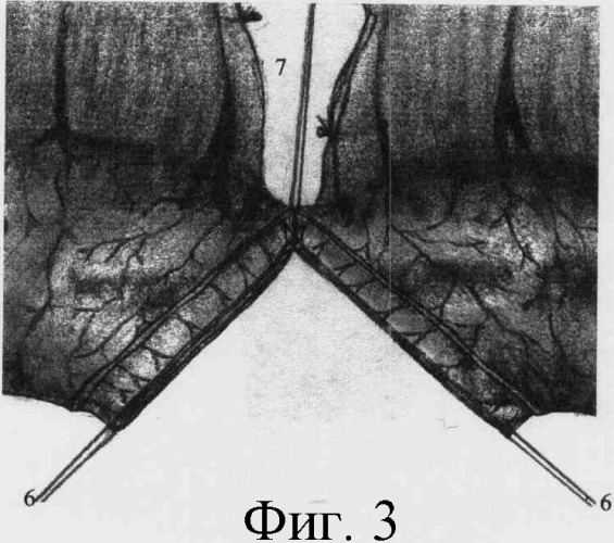 Способ восстановления непрерывности одноименных отделов кишки (патент 2328229)