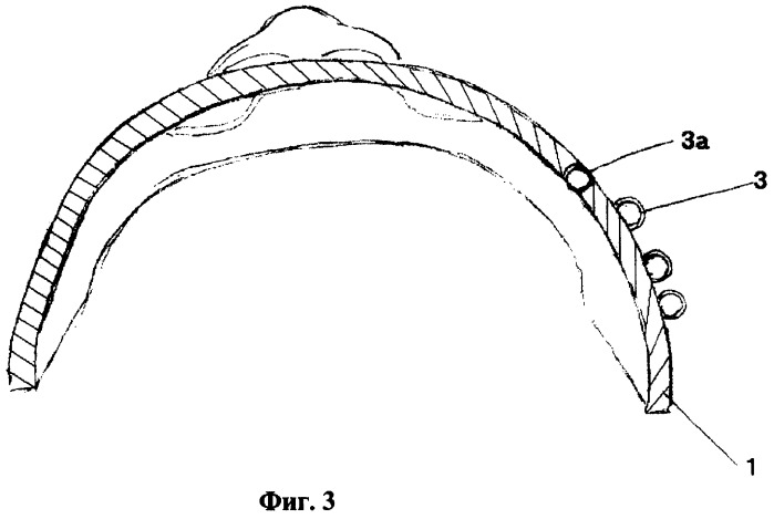 Индивидуальный аппликатор для контактной лучевой терапии (патент 2254881)