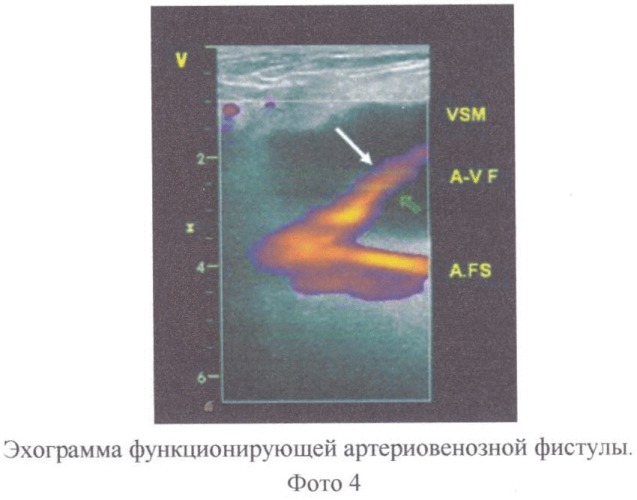 Способ тромбэктомии из глубоких вен нижних конечностей (патент 2423928)