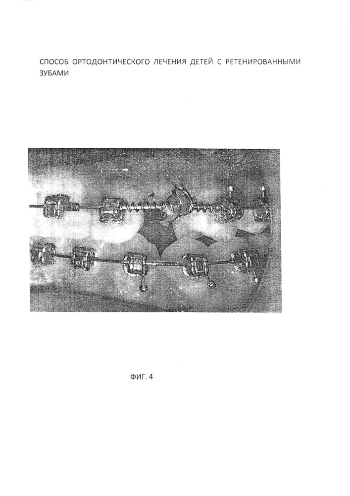 Способ ортодонтического лечения детей с ретенированными зубами (патент 2629061)