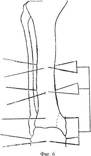 Способ артродеза голеностопного сустава (патент 2328996)