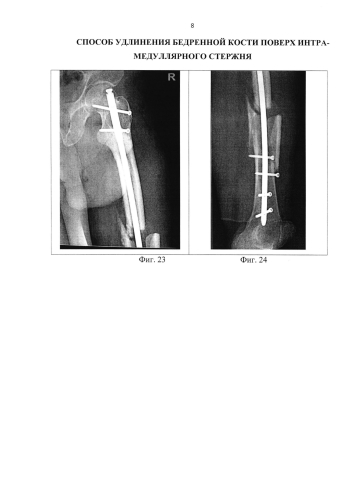 Способ удлинения бедренной кости поверх интрамедуллярного стержня (патент 2584555)