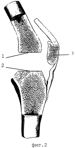 Способ артродезирования коленного сустава (патент 2372042)
