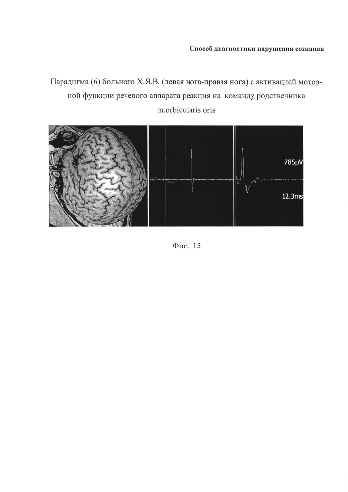 Способ диагностики нарушения сознания (патент 2596049)