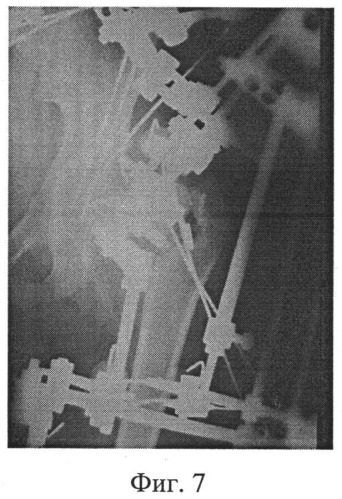Способ лечения деформаций проксимального отдела бедра (патент 2528964)
