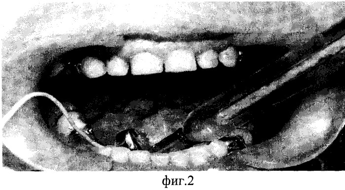 Способ профилактики гальваноза в полости рта (патент 2248180)