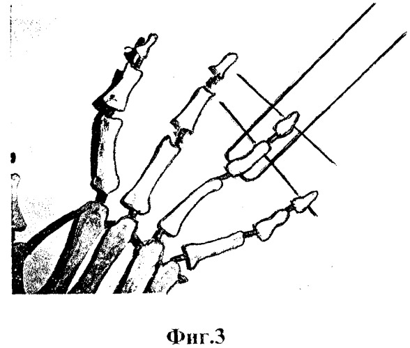 Способ лечения повреждения сухожилия разгибателя пальца кисти на уровне дистальных межфаланговых суставов (патент 2323693)