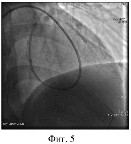 Способ катетеризации коронарных артерий и катетер для его реализации (патент 2556778)