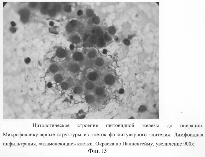 Способ хирургического лечения диффузного токсического зоба (патент 2281040)