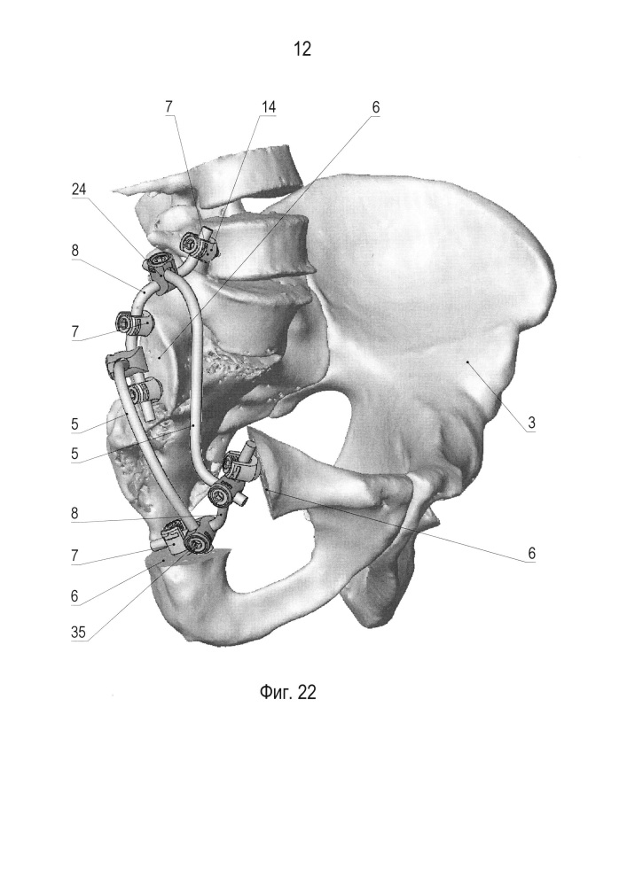 Устройство для реконструкции костей таза (патент 2626122)