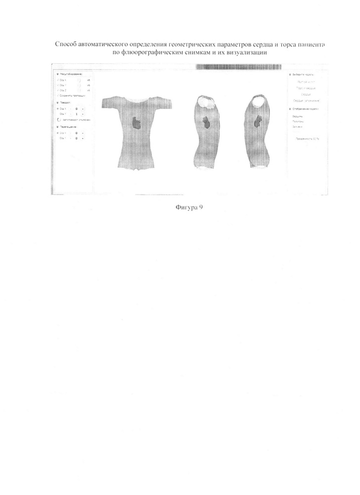 Способ автоматического определения геометрических параметров сердца и торса пациента по флюорографическим снимкам и их визуализации (патент 2639018)