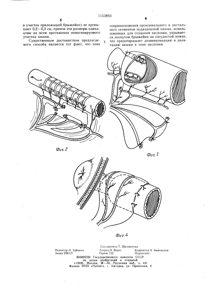 Способ создания удерживающей илеостомы (патент 1153893)