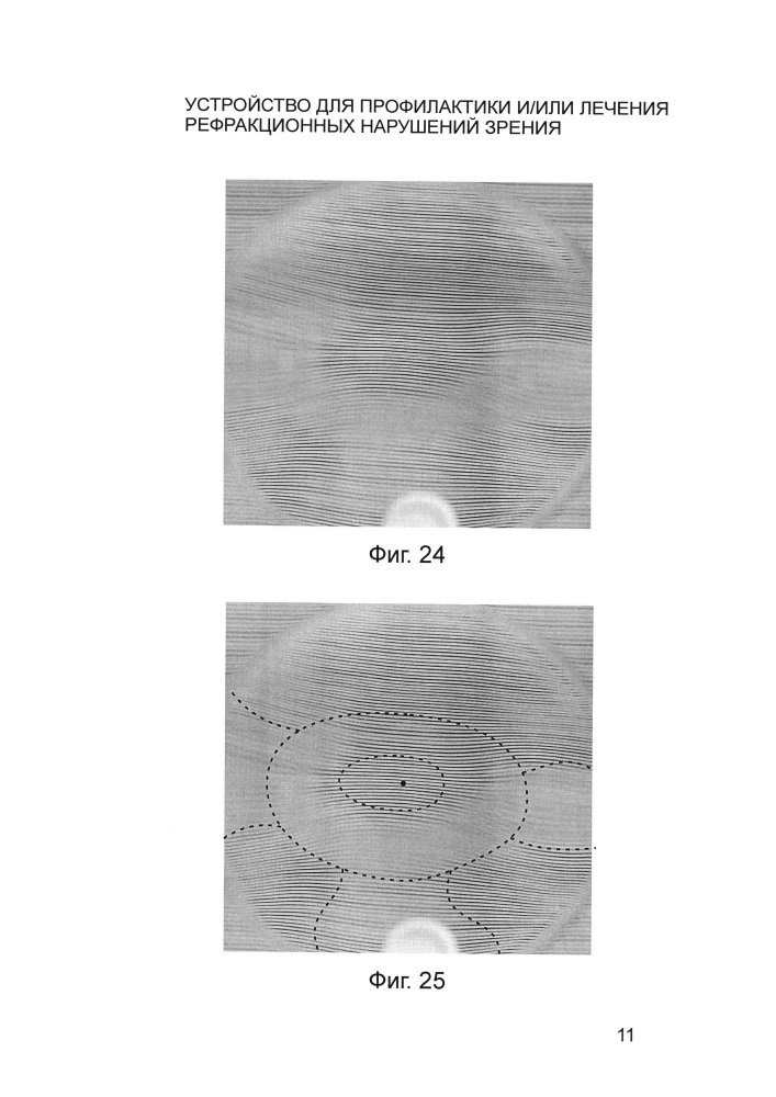 Устройство для профилактики и/или лечения рефракционных нарушений зрения (патент 2644283)