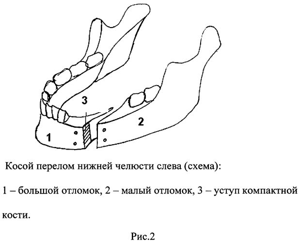 Способ костного шва для фиксации косых переломов нижней челюсти (патент 2565818)