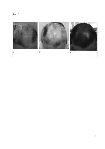 Способ получения средства для лечения нерубцовых алопеций (патент 2583552)