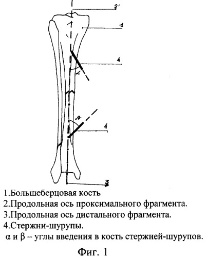 Способ чрескостного остеосинтеза костей голени (патент 2261675)