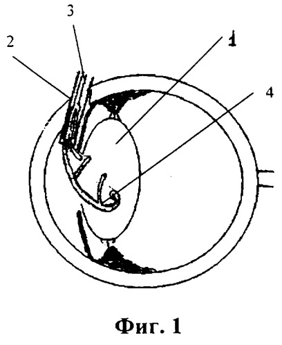 Способ сохранения конфигурации задней капсулы хрусталика и придания объема капсульному мешку при удалении катаракты на глазах с миопией высокой степени (патент 2261070)
