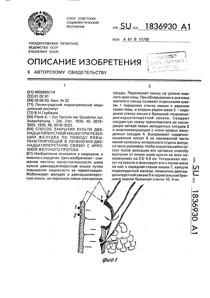 Способ закрытия культи двенадцатиперстной кишки при резекции желудка по поводу язвы, пенетрирующей в печеночно- двенадцатиперстную связку с аррозией желчного протока (патент 1836930)