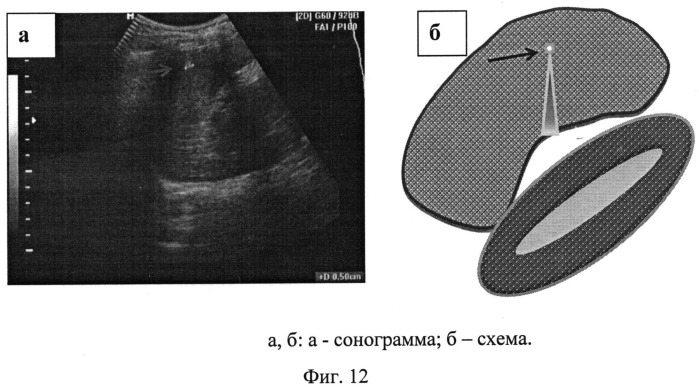 Способ ультразвуковой диагностики воспалительных изменений печени и селезенки при туберкулезе у детей (патент 2535613)