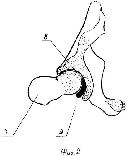 Способ артродеза тазобедренного сустава (патент 2300334)