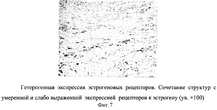 Способ прогнозирования течения заболевания раком молочной железы (патент 2300111)