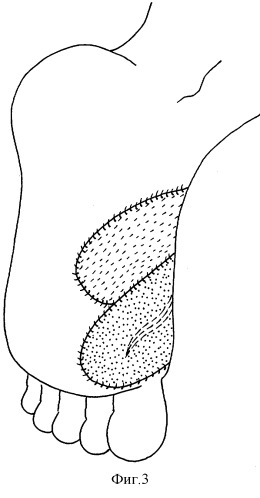 Способ замещения посттравматических дефектов тканей опорной поверхности стопы (патент 2290144)