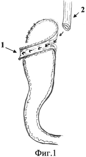 Способ формирования конце-бокового пищеводно-желудочного анастомоза после проксимальной резекции желудка (патент 2535075)