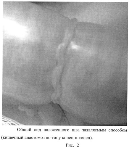 Способ наложения однорядного кишечного шва е.с. петрова (патент 2456932)