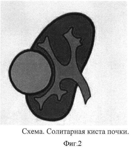 Киста почки мкб 10. Солитарная киста почки кт. Солитарная киста почки снимок. Солитарная киста почки УЗИ. Солитарная киста почки дифференциальная диагностика.