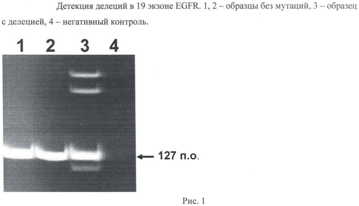 Молекулярно-генетический способ определения чувствительности опухоли у пациентов с раком легкого к терапии гефитинибом (патент 2454464)
