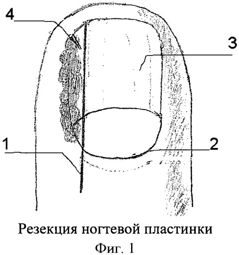 Способ операции при вросшем ногте первого пальца стопы (патент 2460471)