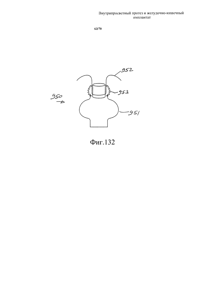 Внутрипросветный протез и желудочно-кишечный имплантат (патент 2626885)